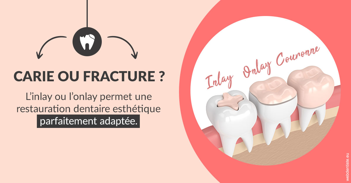 https://dr-fabrice-vernet.chirurgiens-dentistes.fr/T2 2023 - Carie ou fracture 2