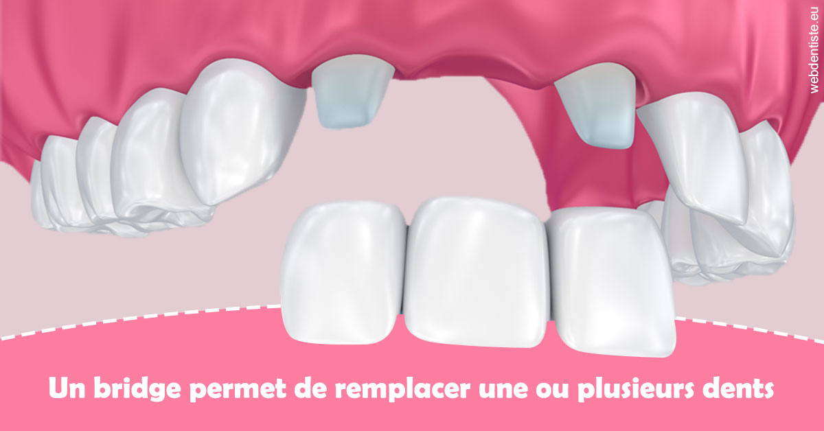 https://dr-fabrice-vernet.chirurgiens-dentistes.fr/Bridge remplacer dents 2