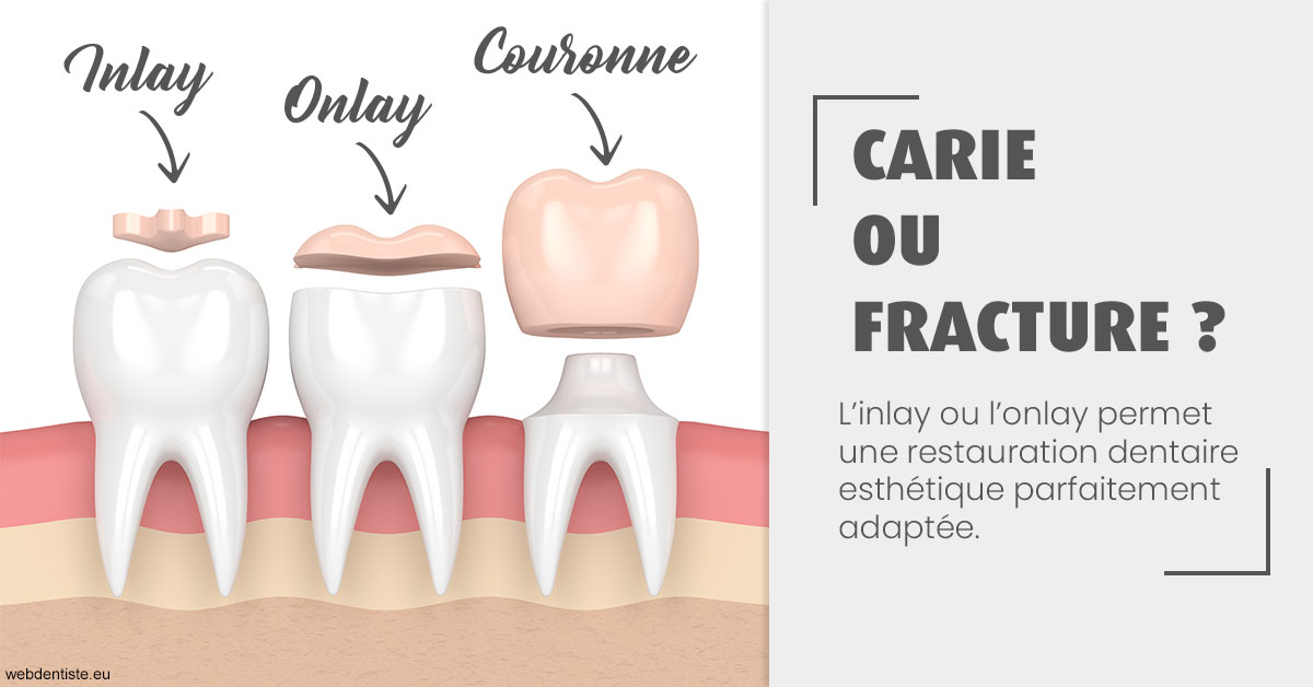https://dr-fabrice-vernet.chirurgiens-dentistes.fr/T2 2023 - Carie ou fracture 1