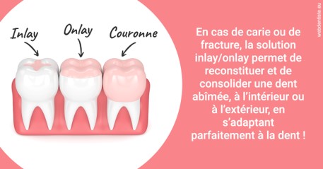 https://dr-fabrice-vernet.chirurgiens-dentistes.fr/L'INLAY ou l'ONLAY 2