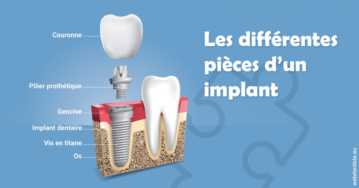 https://dr-fabrice-vernet.chirurgiens-dentistes.fr/Les différentes pièces d’un implant 1