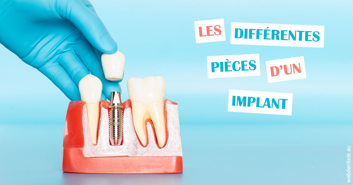 https://dr-fabrice-vernet.chirurgiens-dentistes.fr/Les différentes pièces d’un implant 2