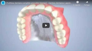 Prothèse dentaire complète amovible (dentier)